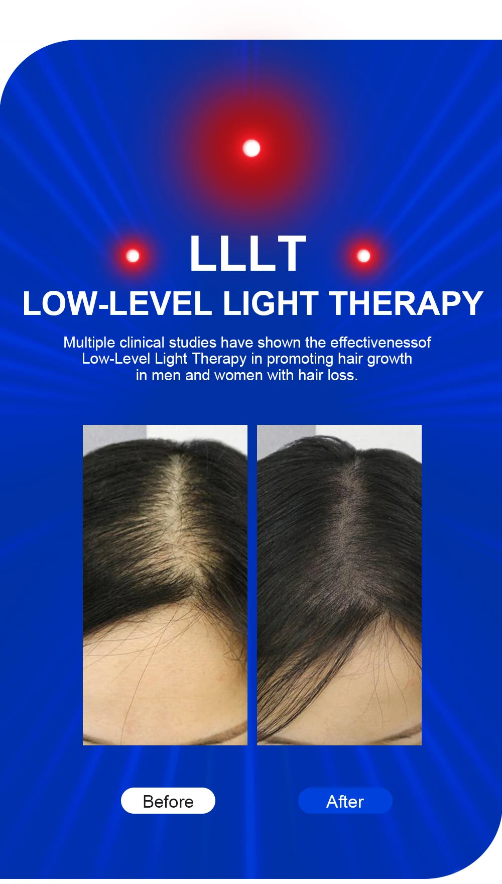 Lescolton Hair Regrow Helmet
